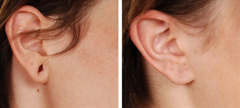 Ear Lobe Repair Ear Piercing Blog